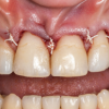 crown lenthening 2