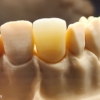 High translucent zirconia (without stain & glaze)