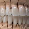 ZIRCONIA