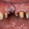 4 Units Bridge Bone Graft