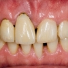 4 Units Bridge Before