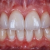 crown lenthening final