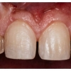 crown lenthening Prep
