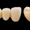 PFM (Porcelain-Fused-to-Metal) - ATTACHMENTS