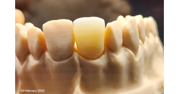 High translucent zirconia (without stain & glaze)