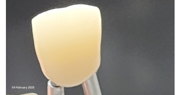 High translucent zirconia without Stain&Glaze (under light)