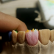 Layering Porcelain 