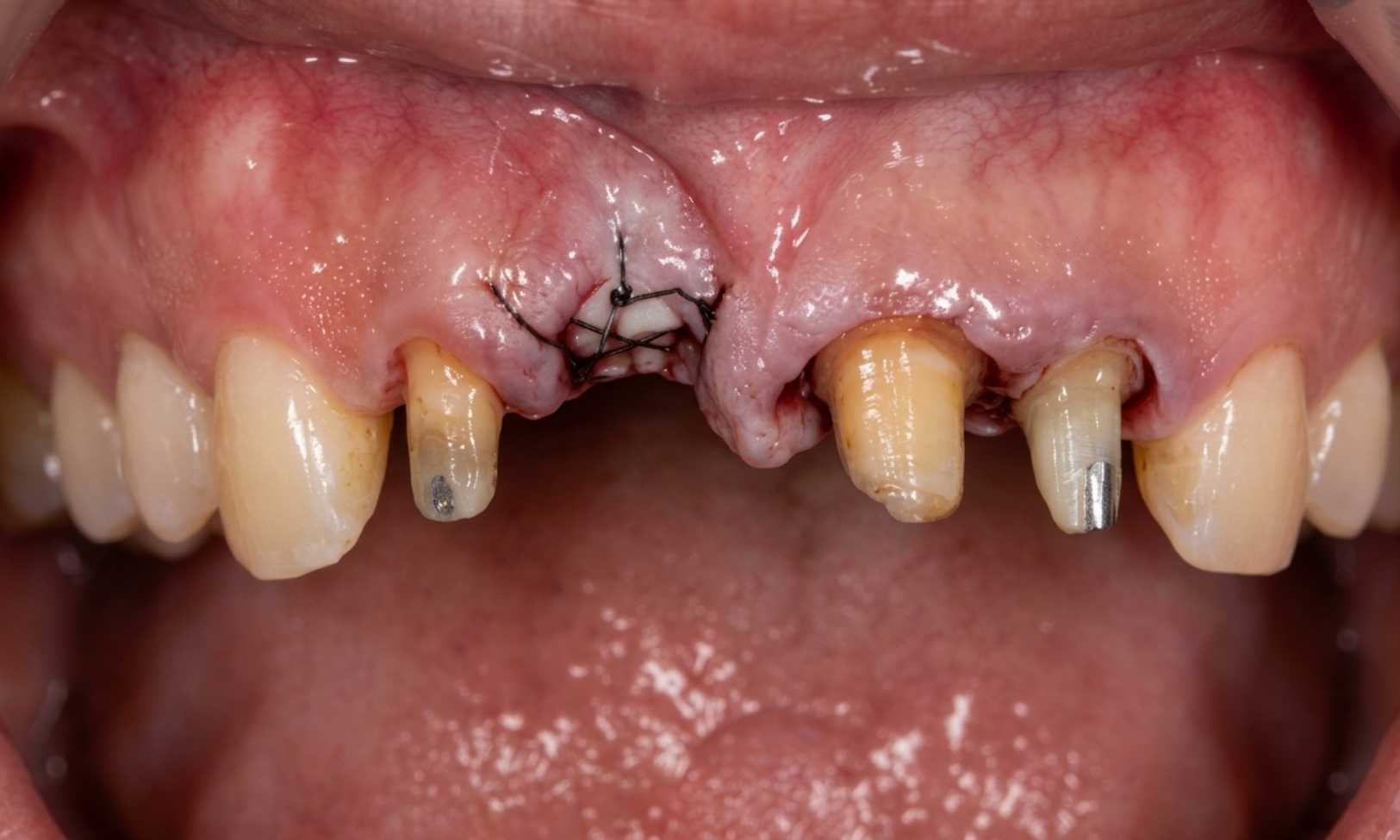 4 Units Bridge Bone Graft