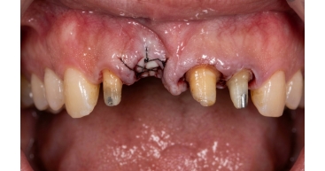 4 Units Bridge Bone Graft