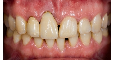 4 Units Bridge Before