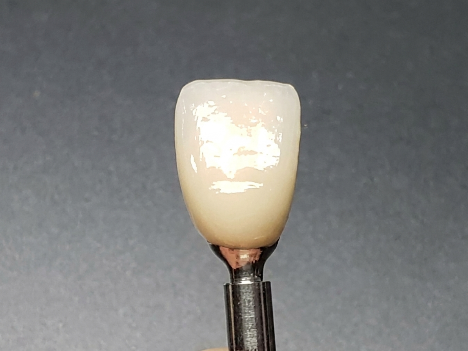 Palatal Cross Screw Implant angulation