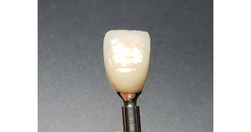 Palatal Cross Screw Implant angulation