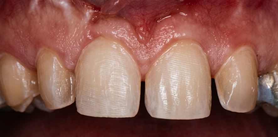 crown lenthening Prep