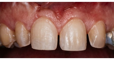 crown lenthening Prep
